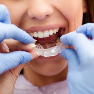 L’orthodontie invisible
